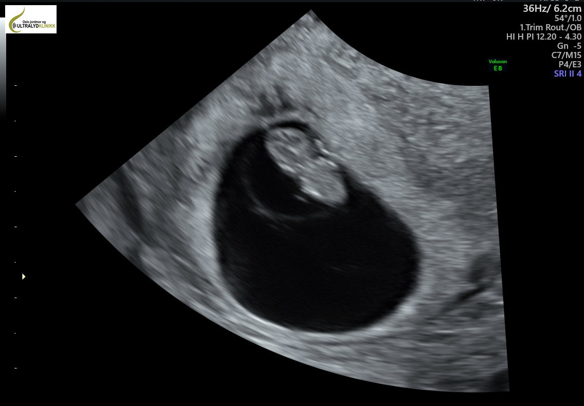 Early ultrasound week 6 7